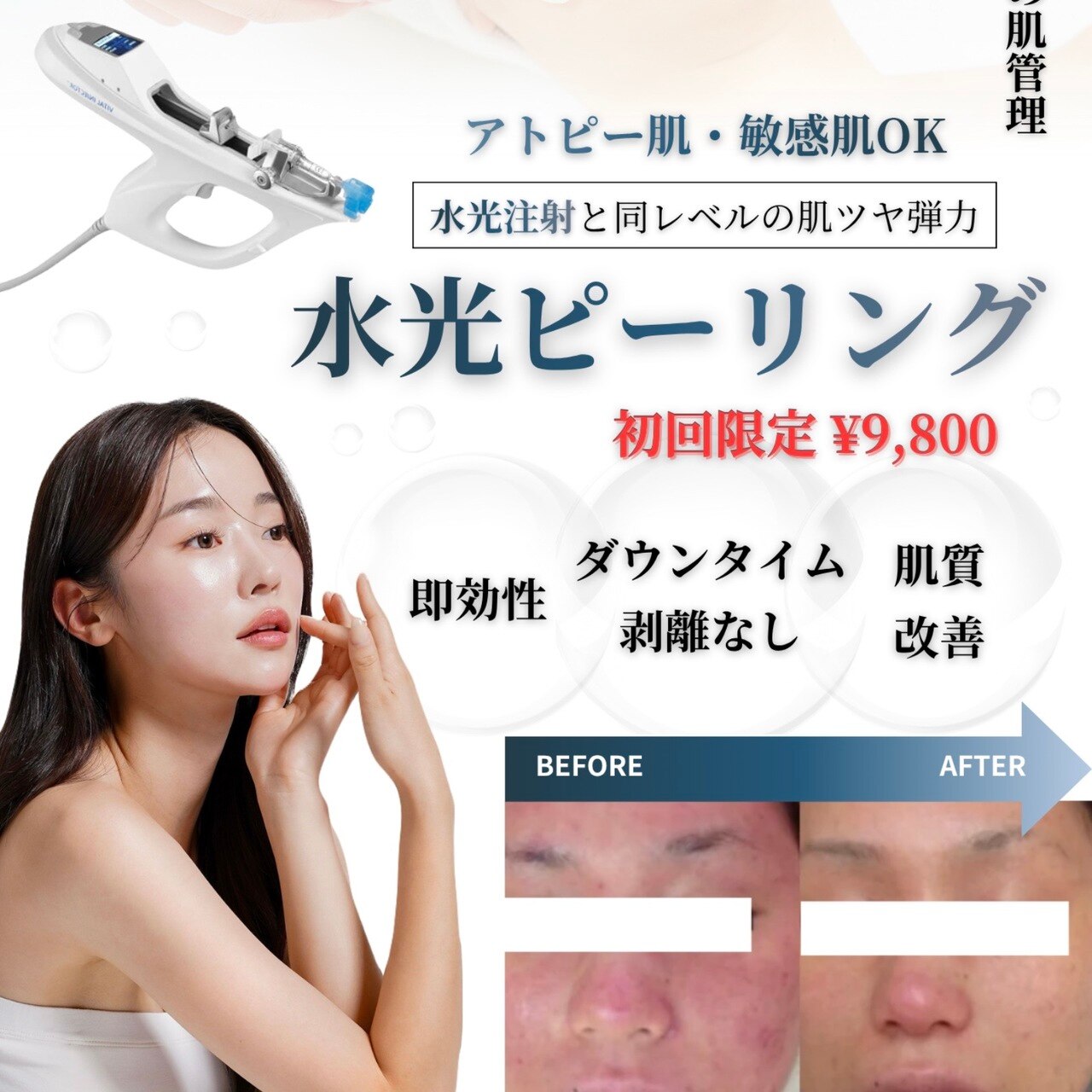 30・40代からの肌管理に水光ピーリング