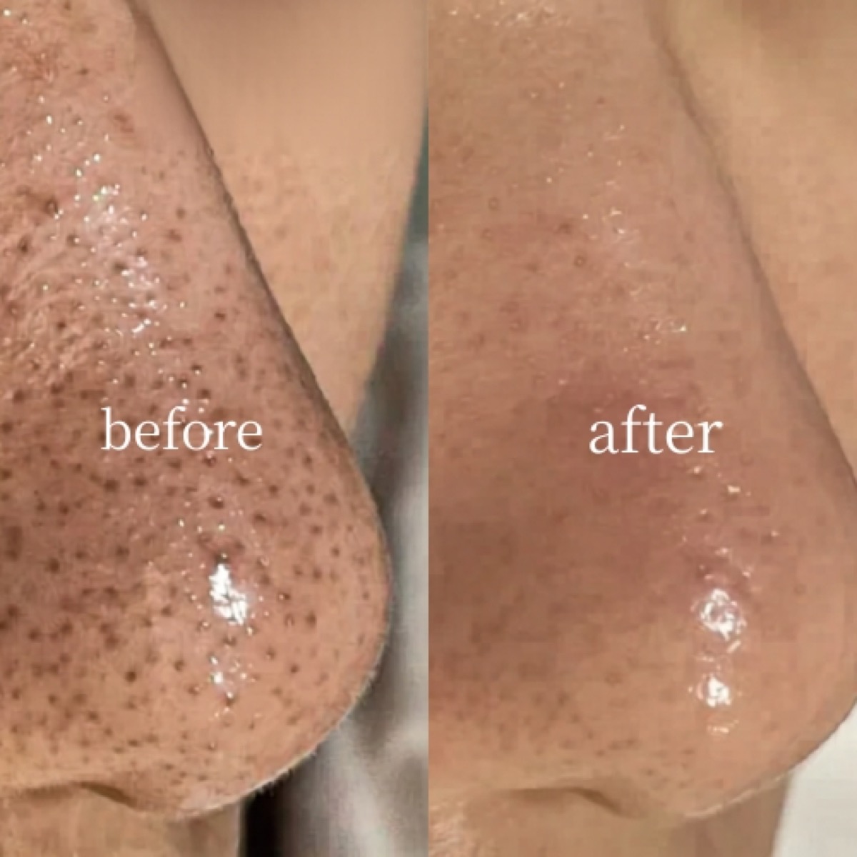 全顔毛穴洗浄 before / after 症例